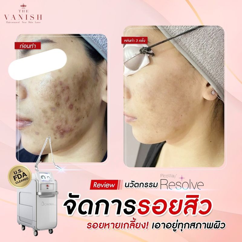 รีวิวลบรอยสิว เลเซอร์ลบรอยสิว