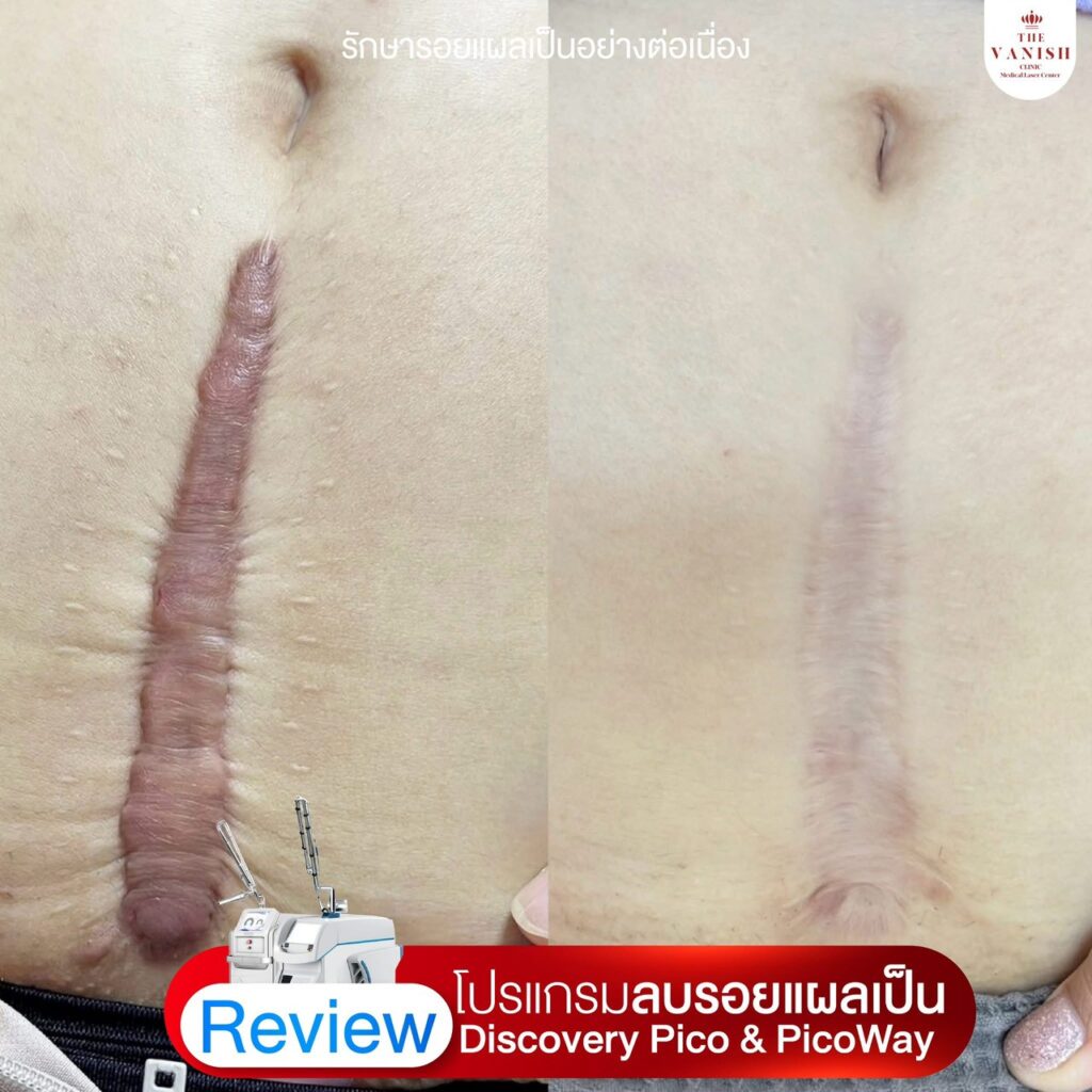 รีวิว เลเซอร์ลดรอยแผลเป็นด้วย Picoway Laser จาก The Vanish Clinic