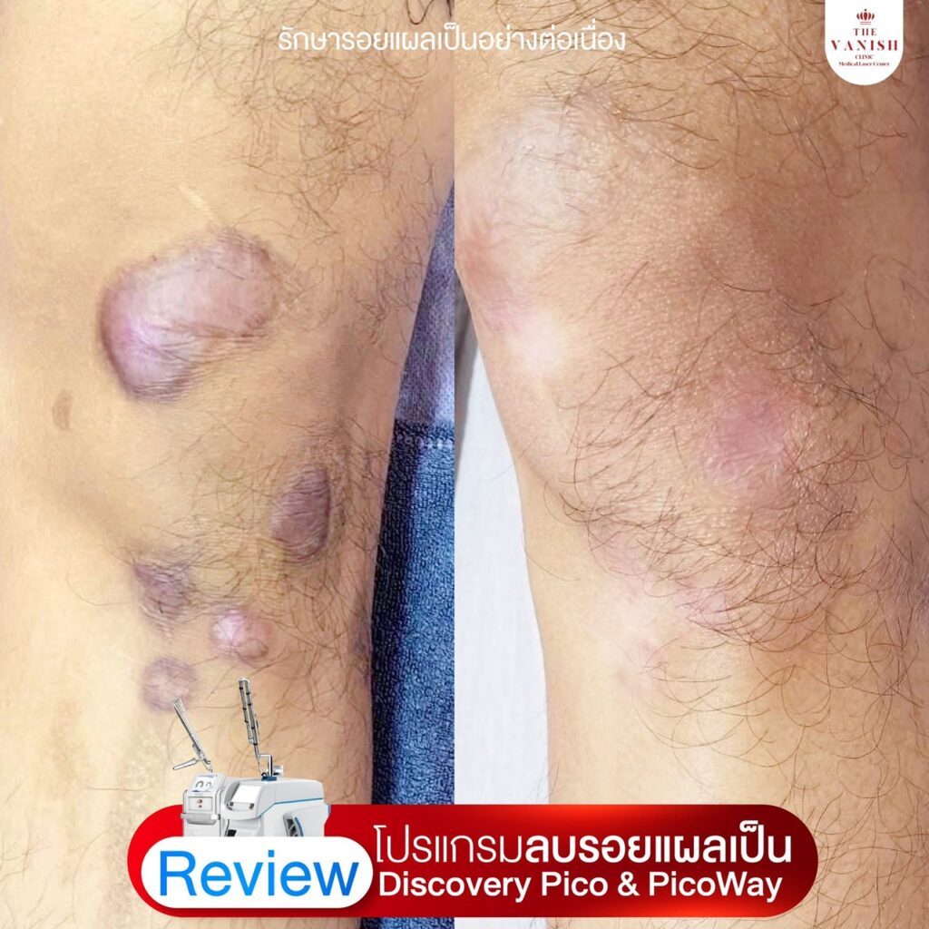 รีวิว เลเซอร์ลดรอยแผลเป็นด้วย Picoway Laser จาก The Vanish Clinic