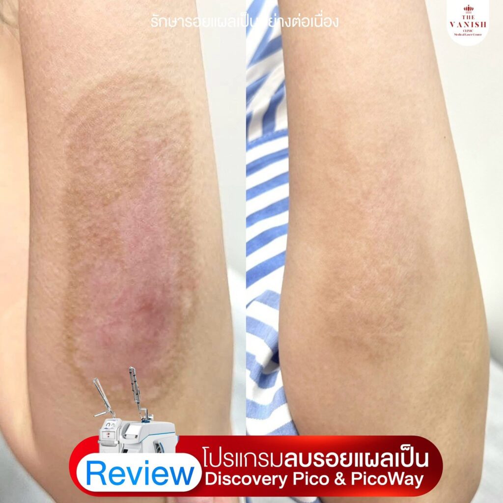 รีวิว เลเซอร์ลดรอยแผลเป็นด้วย Picoway Laser จาก The Vanish Clinic