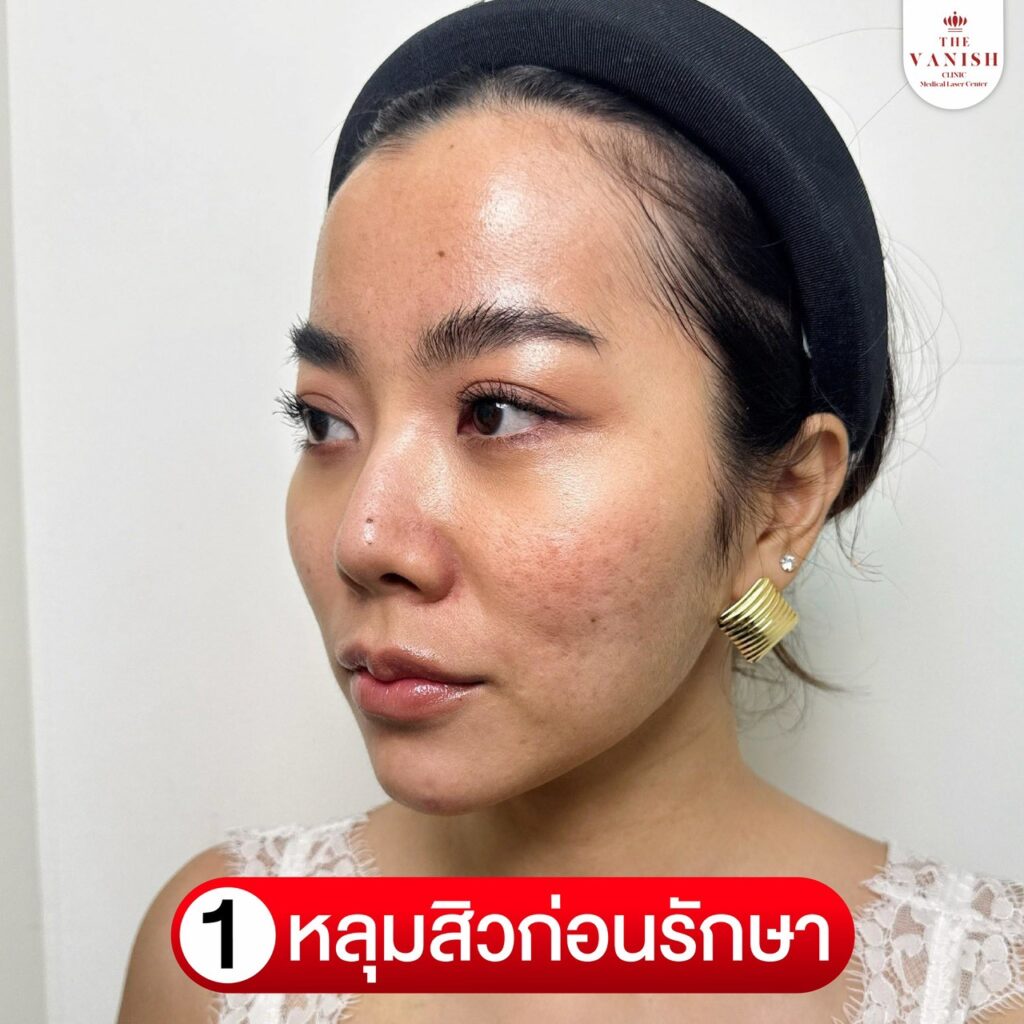 รีวิวทำ PicoWay Laser ที่ The Vanish Clinic : ก่อนการรักษา