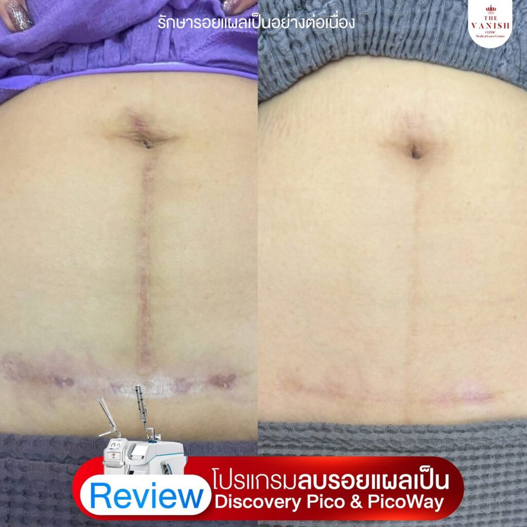 รีวิว เลเซอร์ลดรอยแผลเป็นด้วย Picoway Laser จาก The Vanish Clinic