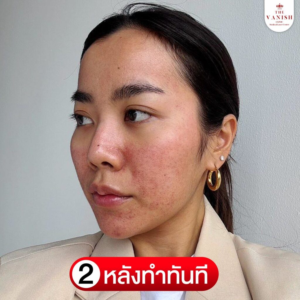 รีวิวทำ PicoWay Laser ที่ The Vanish Clinic :หลังทำทันที