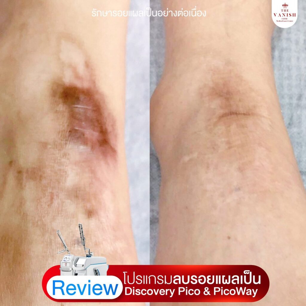 รีวิว เลเซอร์ลดรอยแผลเป็นด้วย Picoway Laser จาก The Vanish Clinic