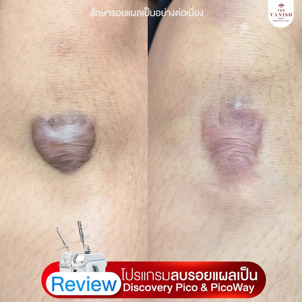 รีวิว เลเซอร์ลดรอยแผลเป็นด้วย Picoway Laser จาก The Vanish Clinic