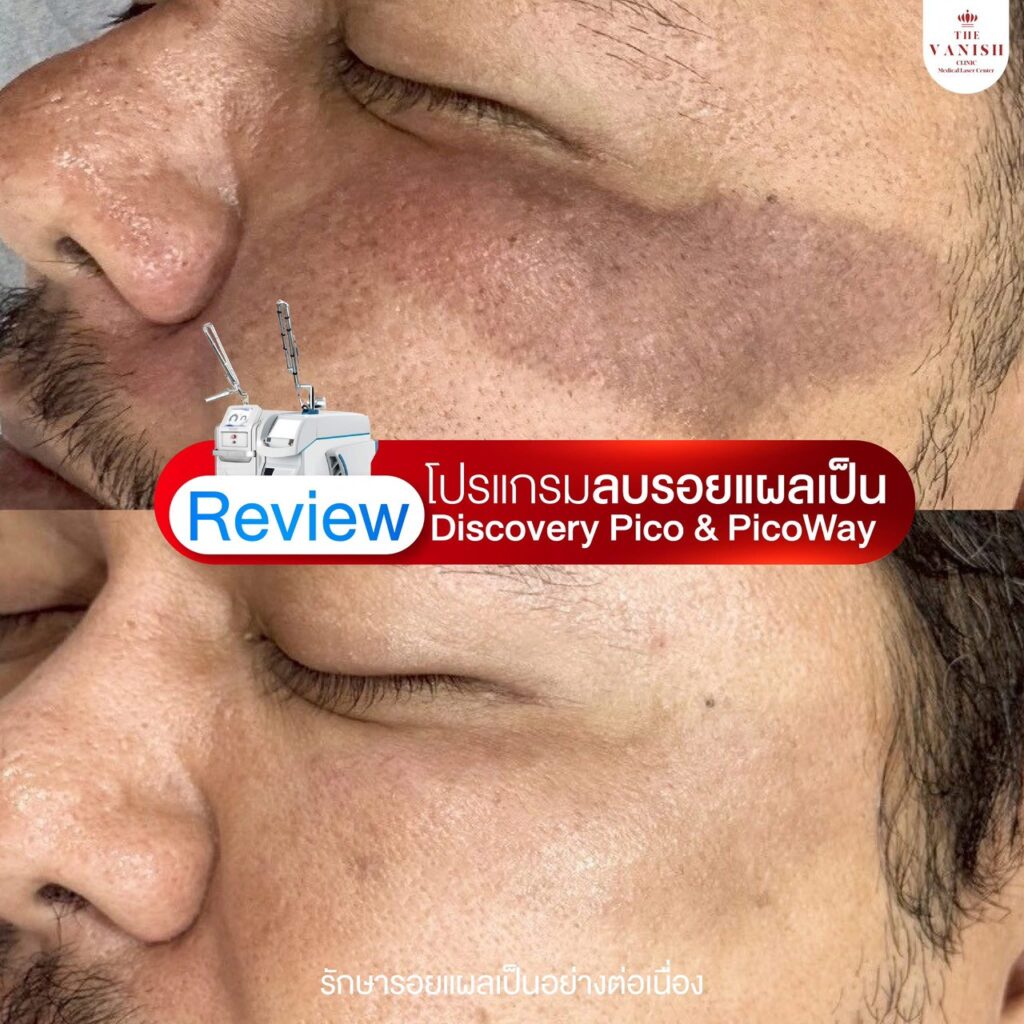 รีวิว เลเซอร์ลดรอยแผลเป็นด้วย Picoway Laser จาก The Vanish Clinic