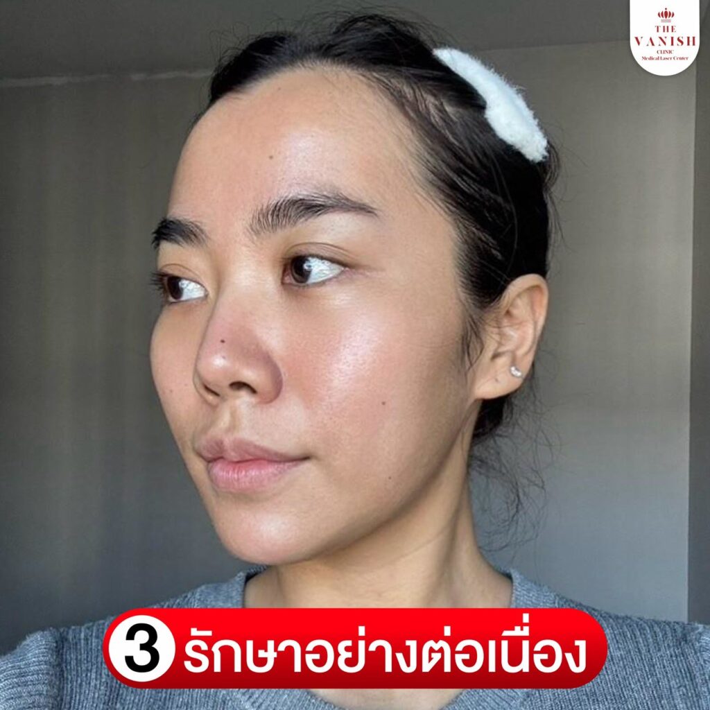 รีวิวทำ PicoWay Laser ที่ The Vanish Clinic : ทำอย่างต่อเนื่อง
