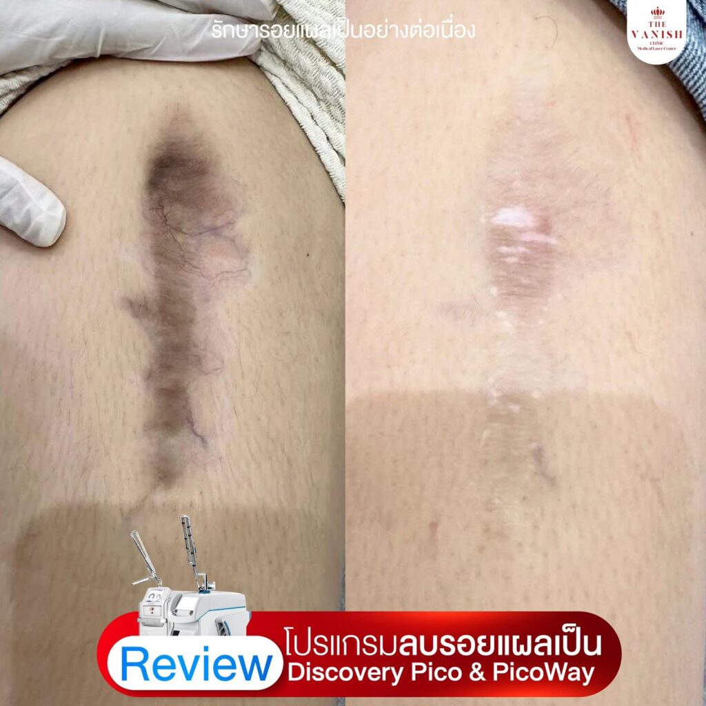 รีวิว เลเซอร์ลดรอยแผลเป็นด้วย Picoway Laser จาก The Vanish Clinic