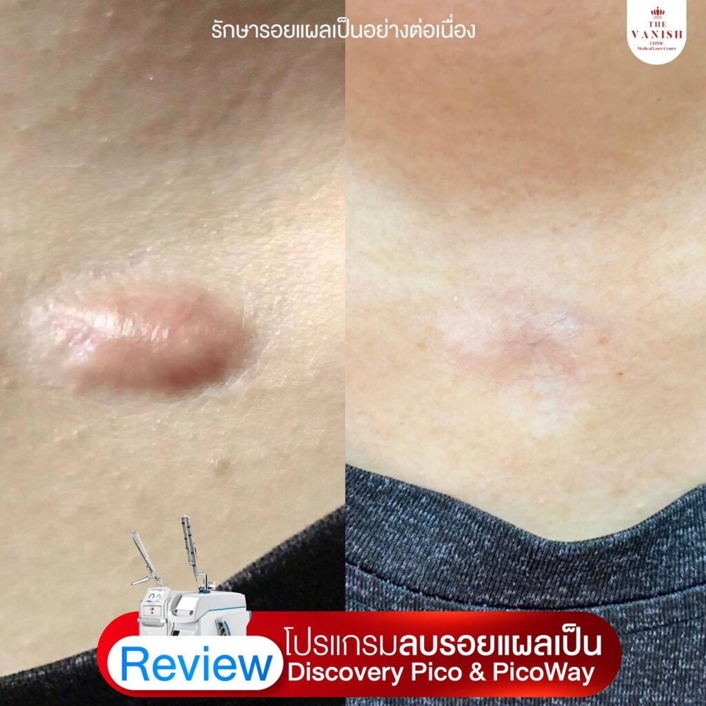 รีวิว เลเซอร์ลดรอยแผลเป็นด้วย Picoway Laser จาก The Vanish Clinic