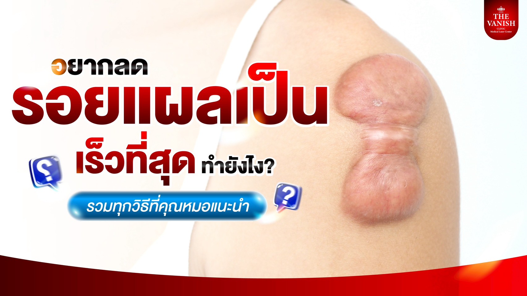 อยากลดรอยแผลเป็นเร็วที่สุด ทำยังไง? รวมทุกวิธีที่คุณหมอแนะนำ