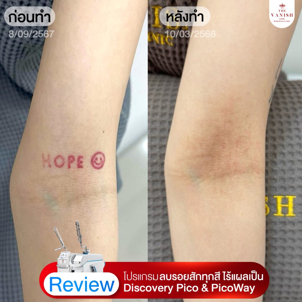 รีวิวเลเซอร์ลบรอยสัก Picoway Laser