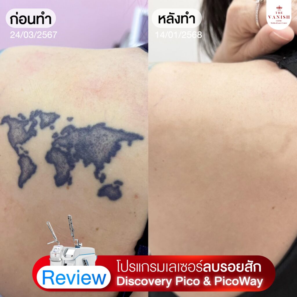 รีวิวเลเซอร์ลบรอยสัก Picoway Laser ที่ The Vanish Clinic
