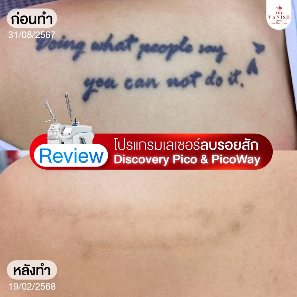 รีวิวเลเซอร์ลบรอยสัก Picoway Laser