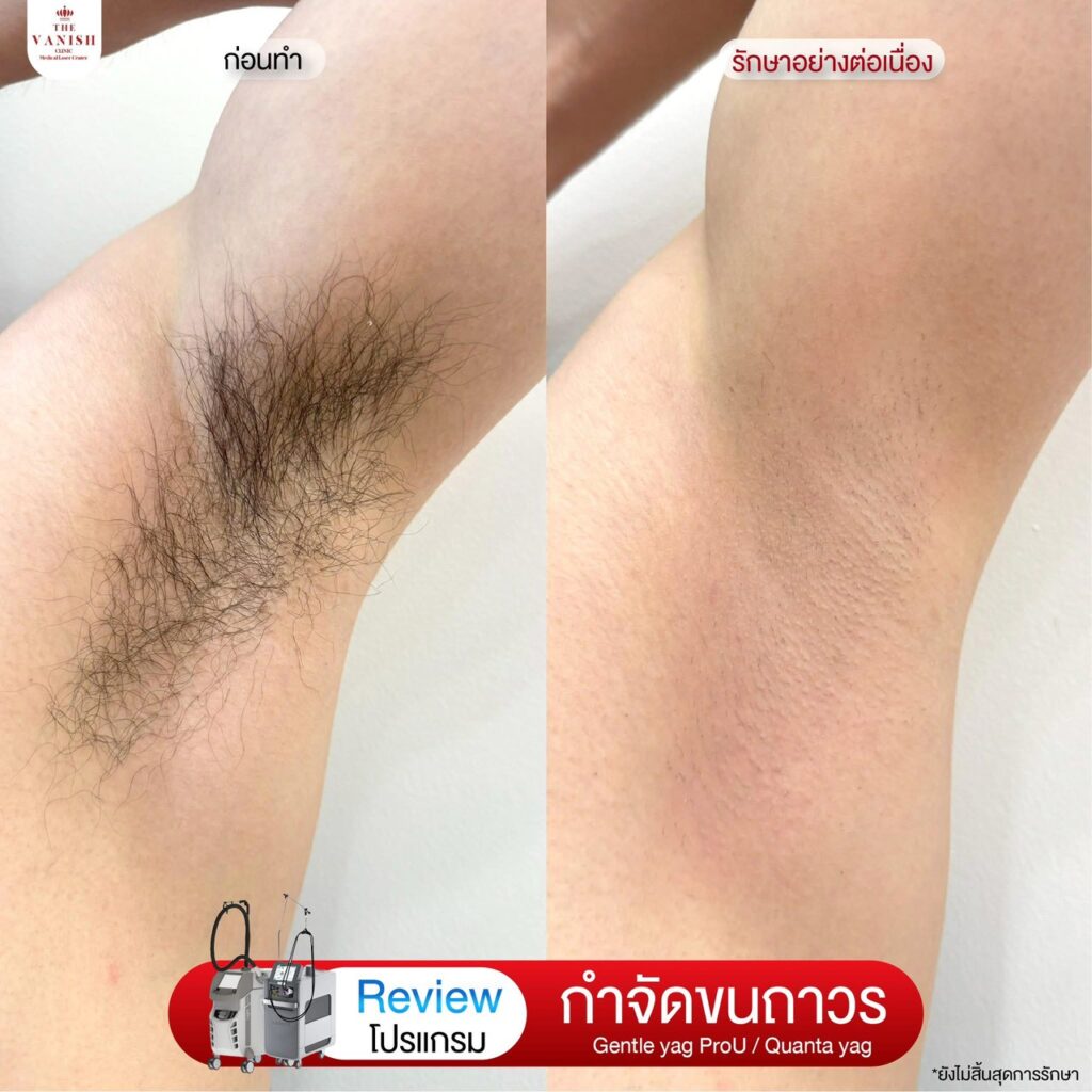 รีวิวเลเซอร์กำจัดขน ที่ The Vanish Clinic