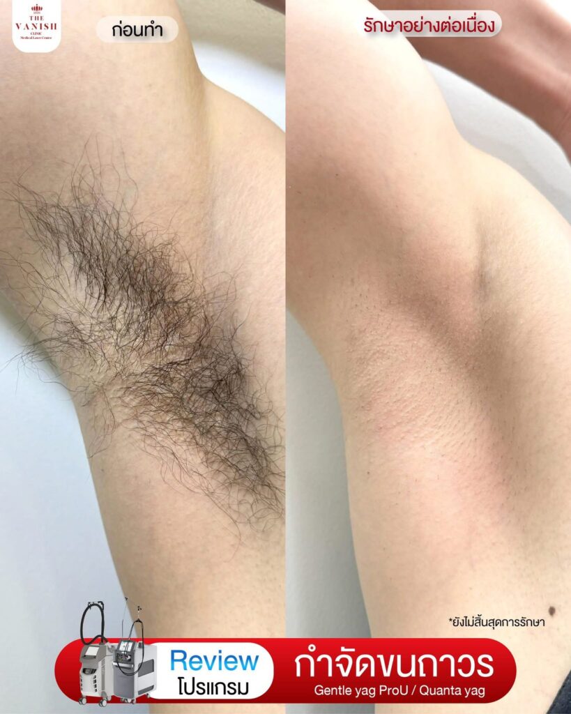 รีวิวเลเซอร์กำจัดขน ที่ The Vanish Clinic