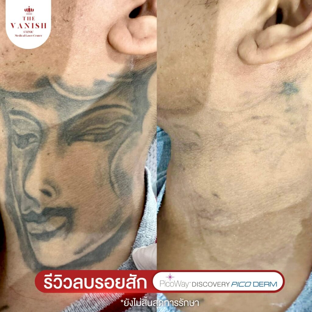 รีวิวเลเซอร์ลบรอยสัก Picoway Laser