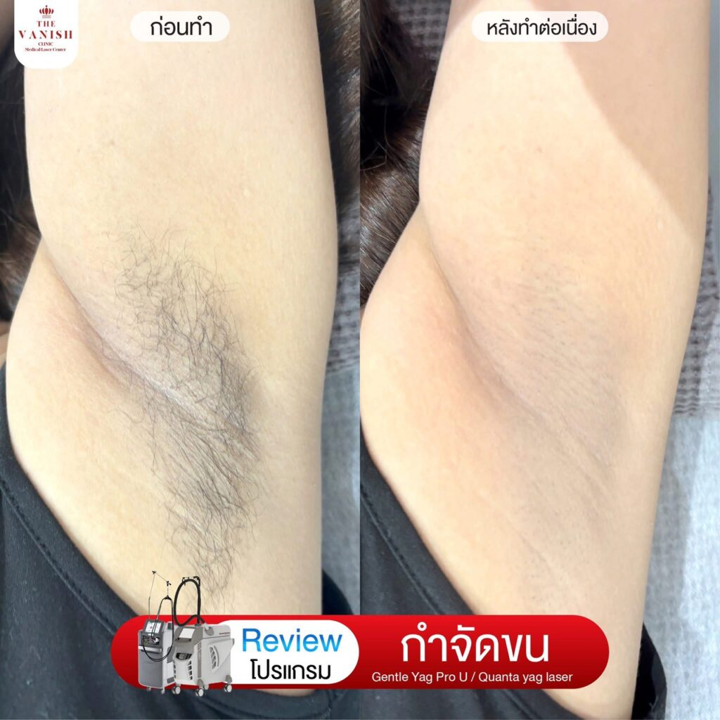 รีวิวเลเซอร์กำจัดขน ที่ The Vanish Clinic