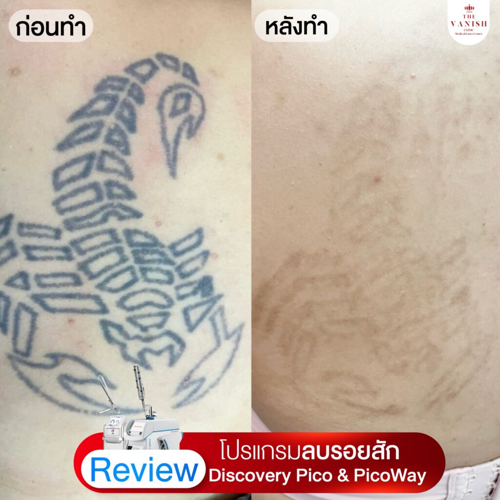 รีวิวเลเซอร์ลบรอยสัก Picoway Laser ที่ The Vanish Clinic