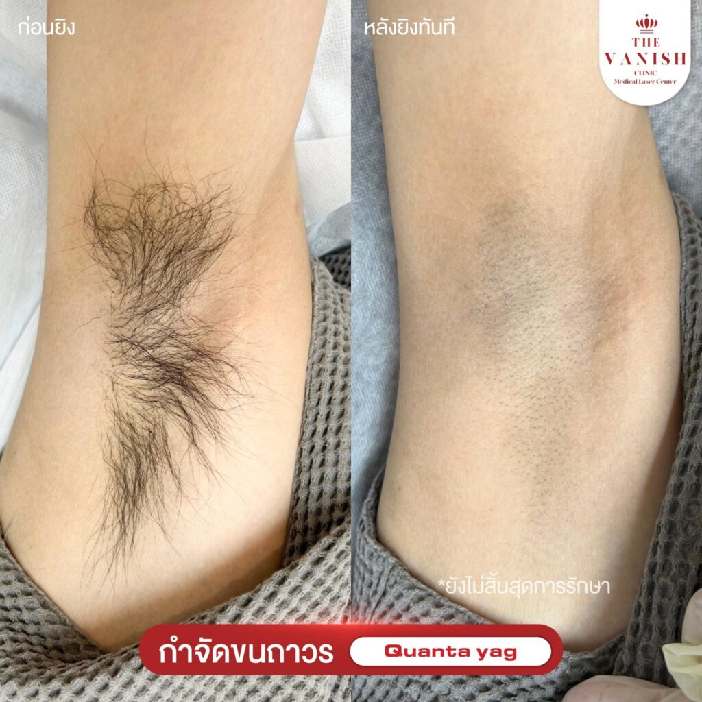 รีวิวเลเซอร์กำจัดขน ที่ The Vanish Clinic