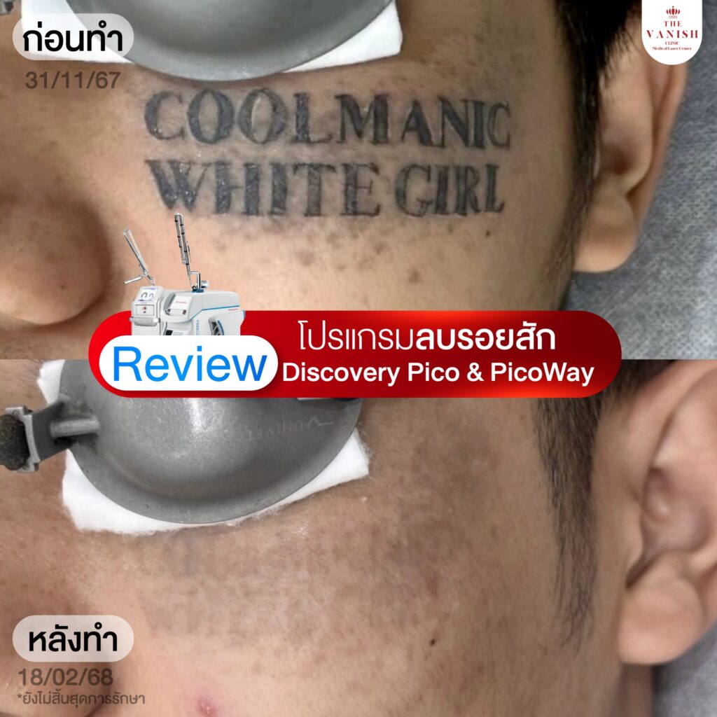 รีวิวเลเซอร์ลบรอยสัก Picoway Laser ที่ The Vanish Clinic