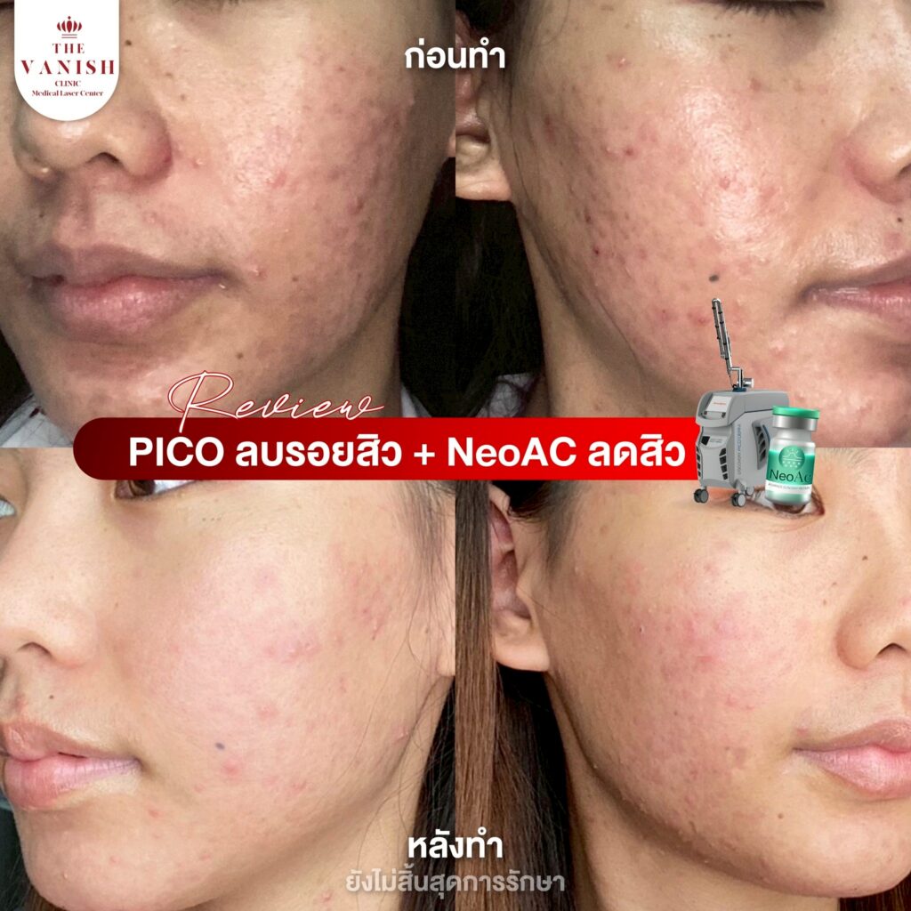 รีวิว NeoAc ที่ The Vanish Clinic