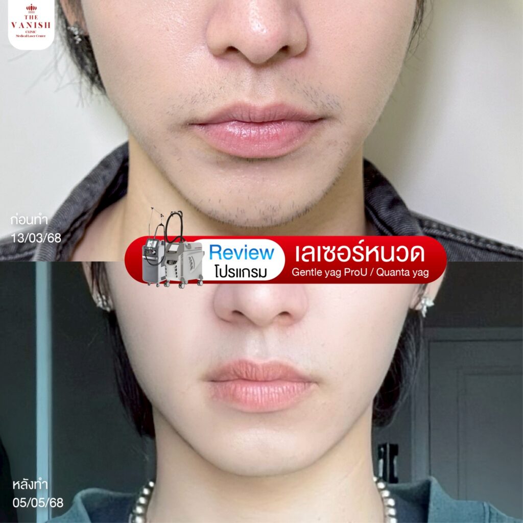 รีวิวเลเซอร์หนวด The Vanish Clinic ในบทความ โกนขนแล้วคัน