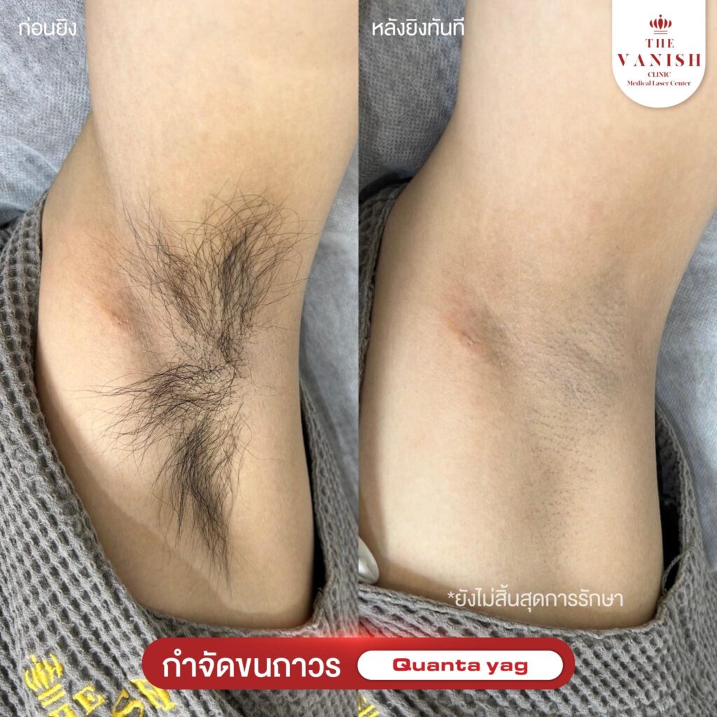 รีวิวเลเซอร์กำจัดขน The Vanish Clinic ในบทความ โกนขนแล้วคัน