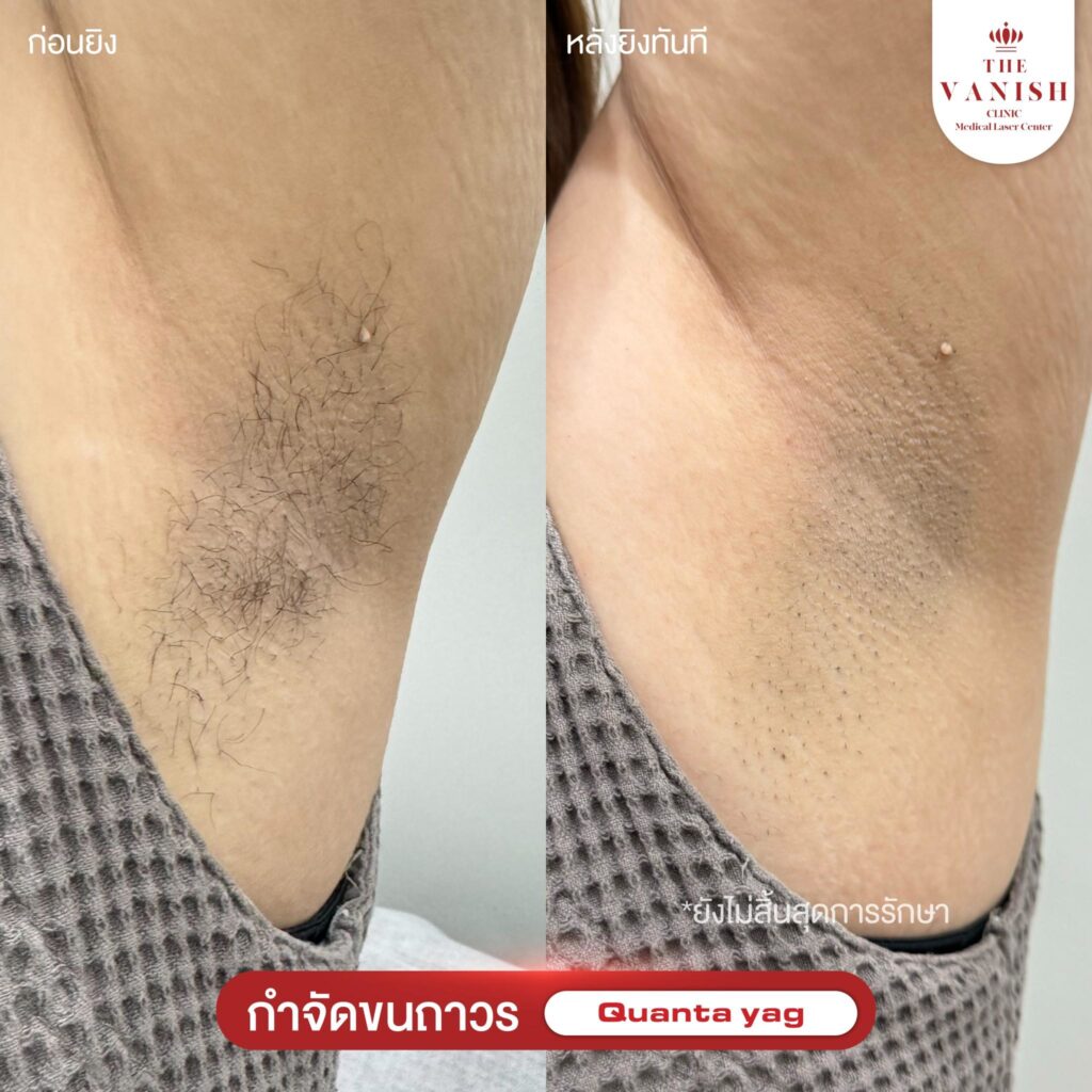 รีวิวเลเซอร์กำจัดขน ที่ The Vanish Clinic