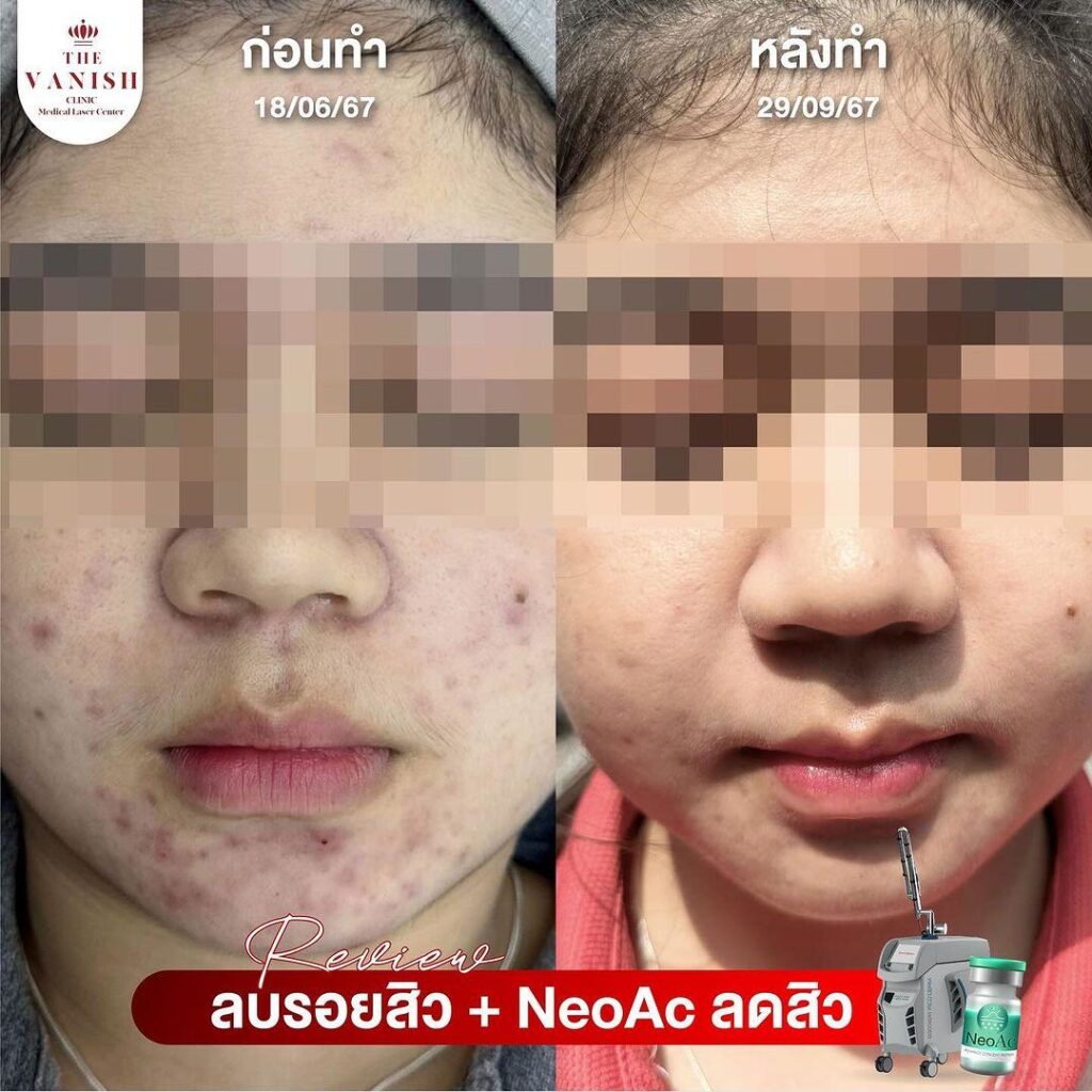 รีวิว NeoAc ที่ The Vanish Clinic