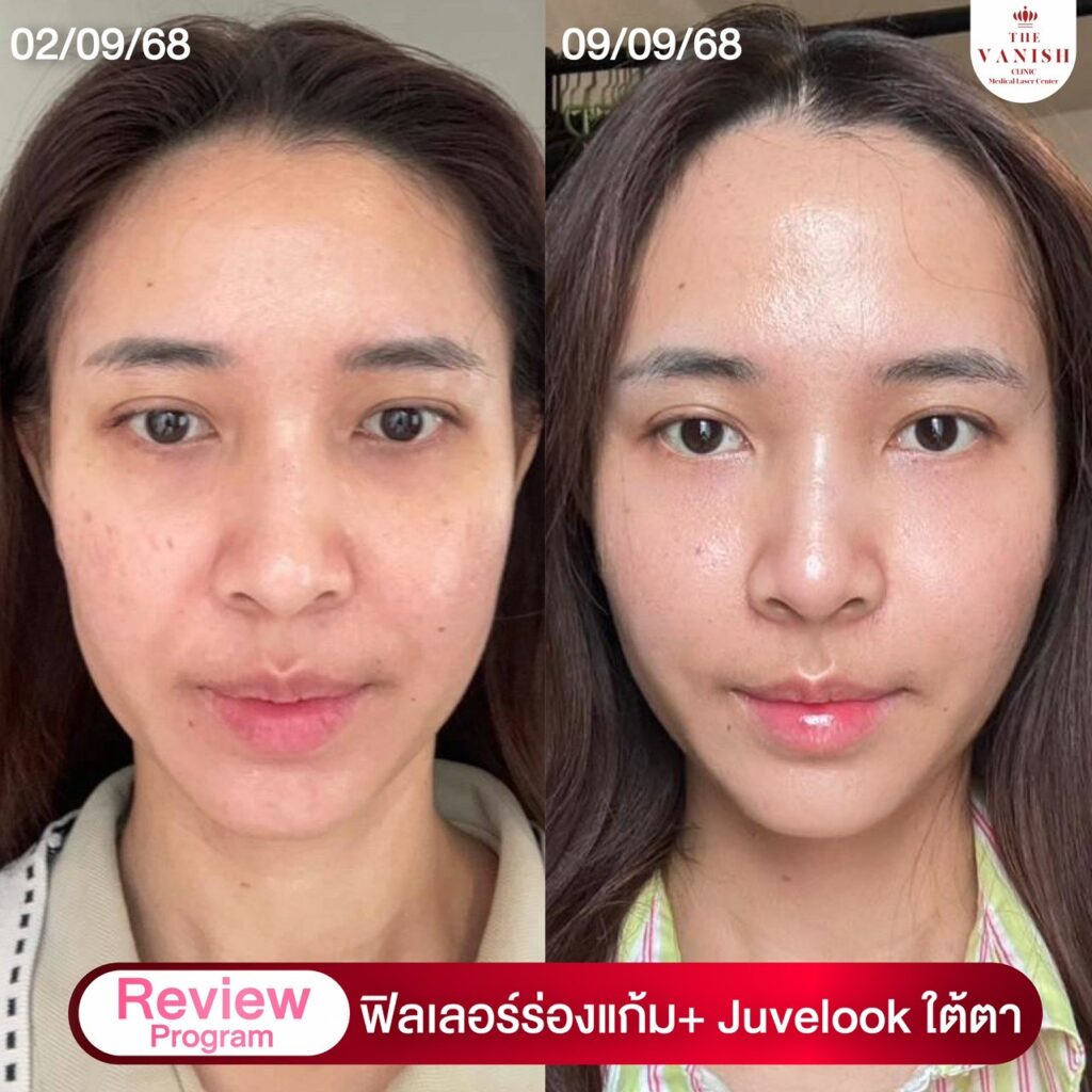 รีวิว Skin Booster ตัวดัง Juvelook จาก The Vanish Clinic