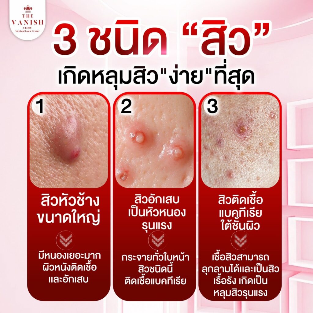 ประเภทของสิวอักเสบ ที่ทำให้เกิดหลุมสิว