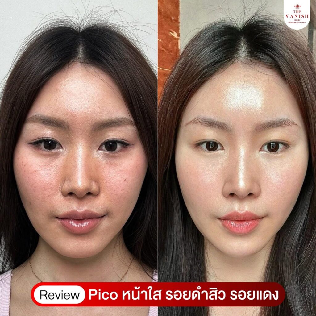 รีวิวเลเซอร์หน้าใสที่ The Vanish Clinic