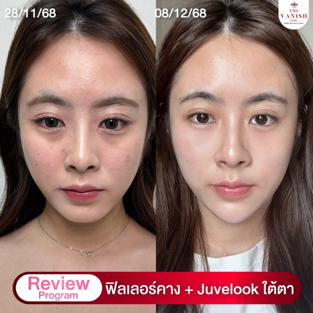 รีวิว Skin Booster ตัวดัง Juvelook จาก The Vanish Clinic