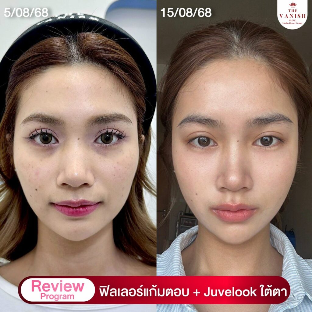 รีวิว Skin Booster ตัวดัง Juvelook จาก The Vanish Clinic
