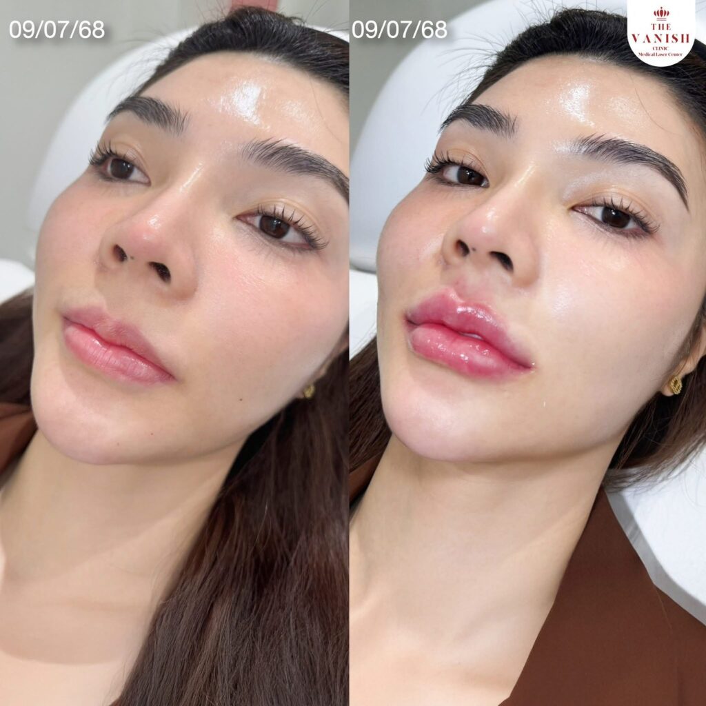 รีวิวฉีดฟิลเลอร์ปาก จากผู้ฉีดจริง The Vanish Clinic