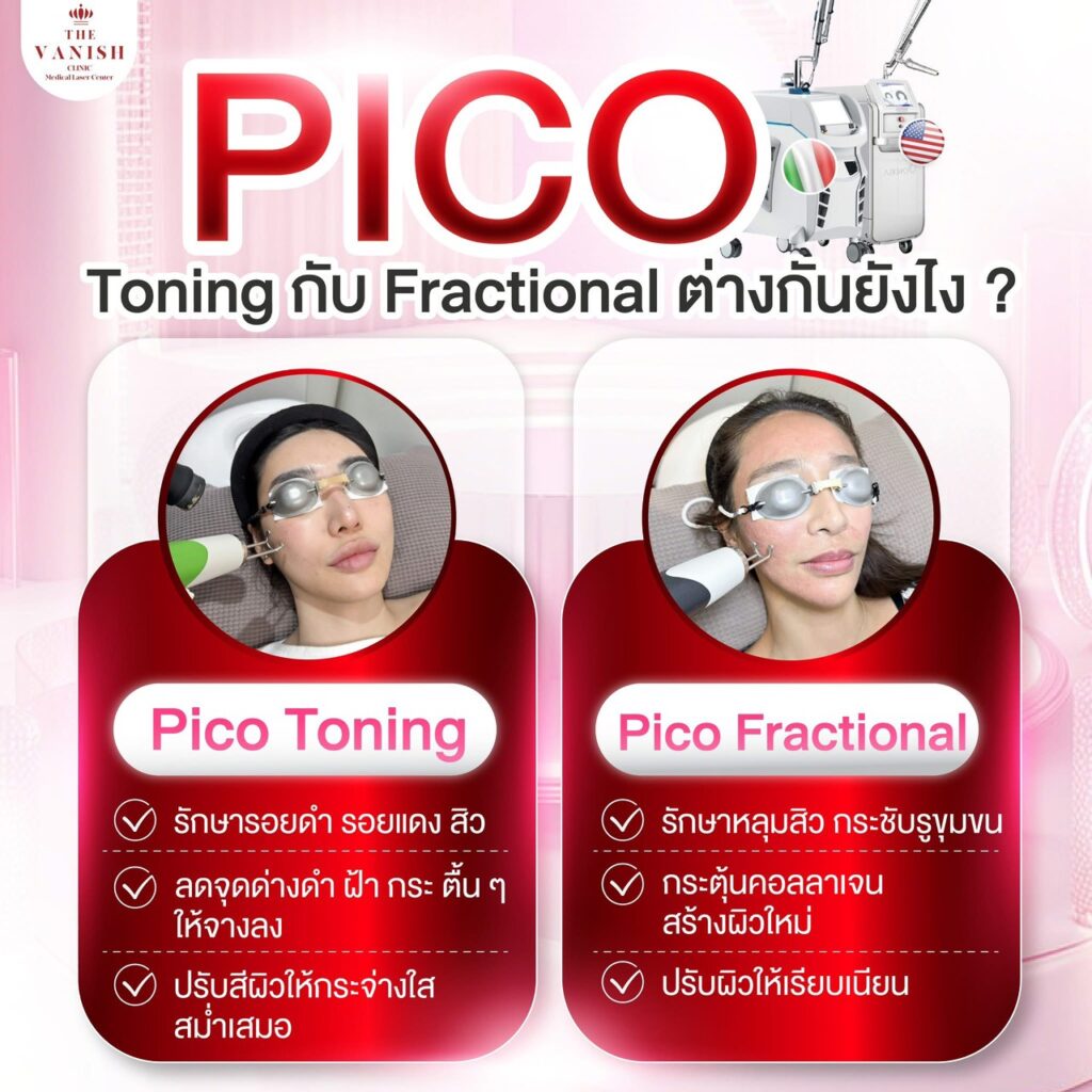 การกระตุ้นคอลลาเจนใต้ชั้นผิวหนัง (Fractional Laser)