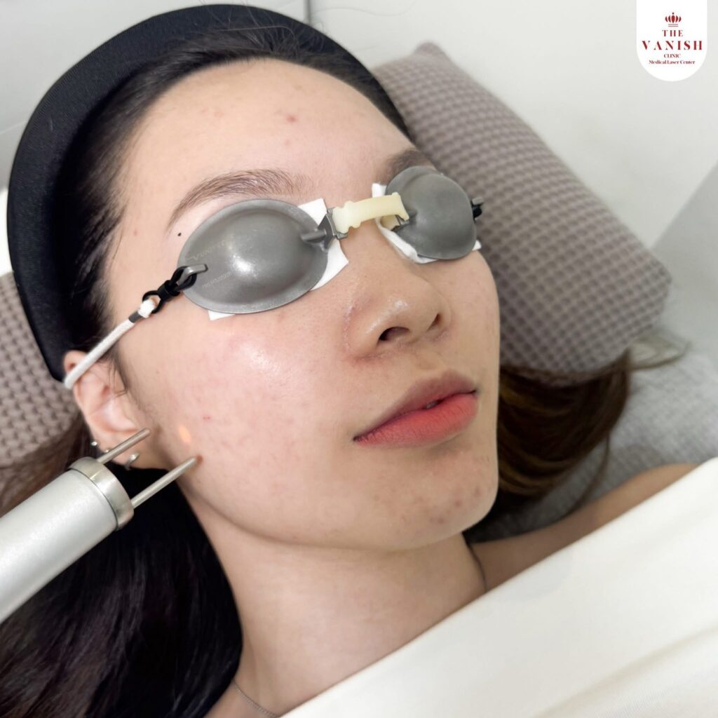 รักษาสิวจากความเครียดด้วย NeoAc