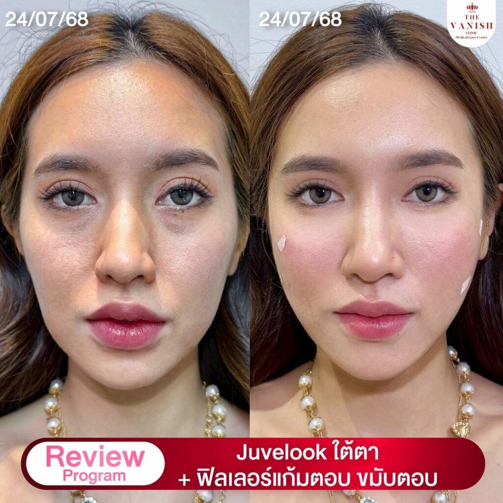 รีวิว ทำ Biostimulator อย่างการฉีด Juvelook ที่ The Vanish Clinic