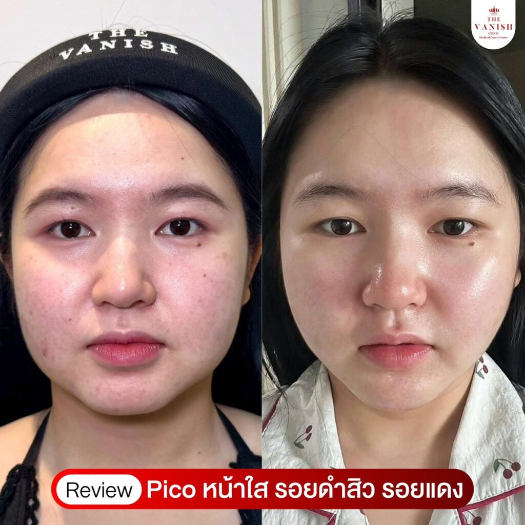 รีวิวเลเซอร์หน้าใสที่ The Vanish Clinic