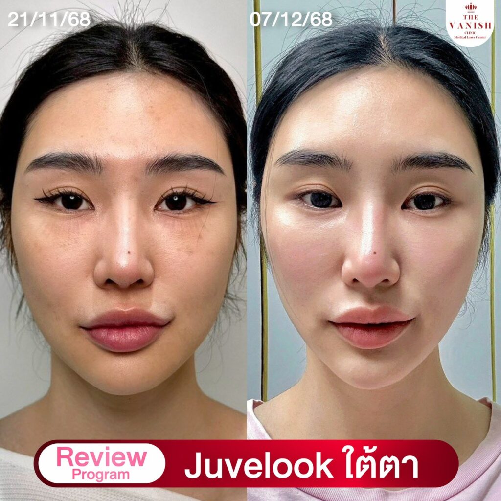 รีวิว ทำ Biostimulator อย่างการฉีด Juvelook ที่ The Vanish Clinic