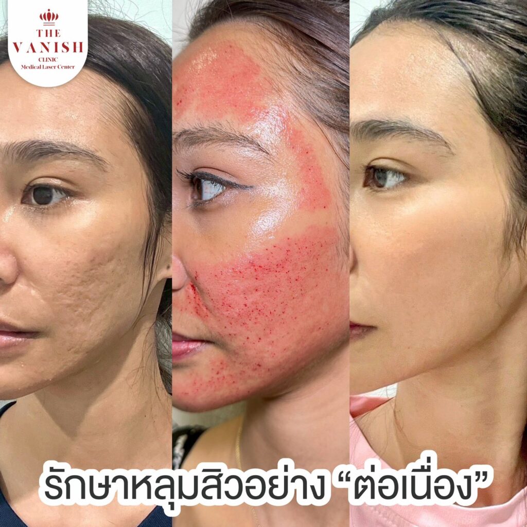 รีวิวรักษาสิวอักเสบ และหลุมสิวอย่างต่อเนื่องที่ The Vanish Clinic