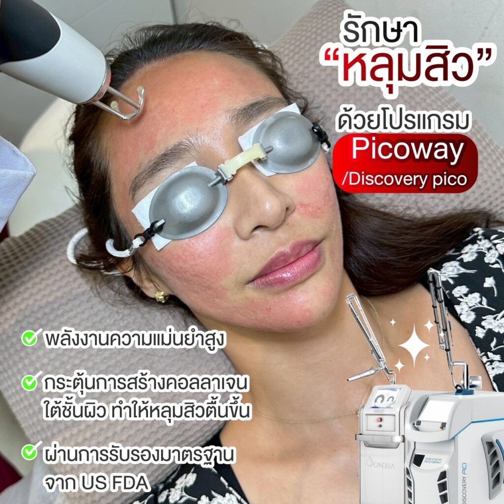 รักษาหลุมสิว รอยสิว ด้วย Picoway / Discovery Pico ที่ The Vanish Clinic
