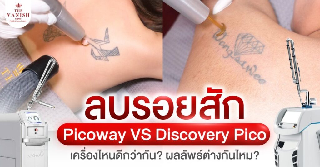 ลบรอยสัก Picoway VS Discovery Pico เครื่องไหนดีกว่ากัน ต่างกันอย่างไร?
