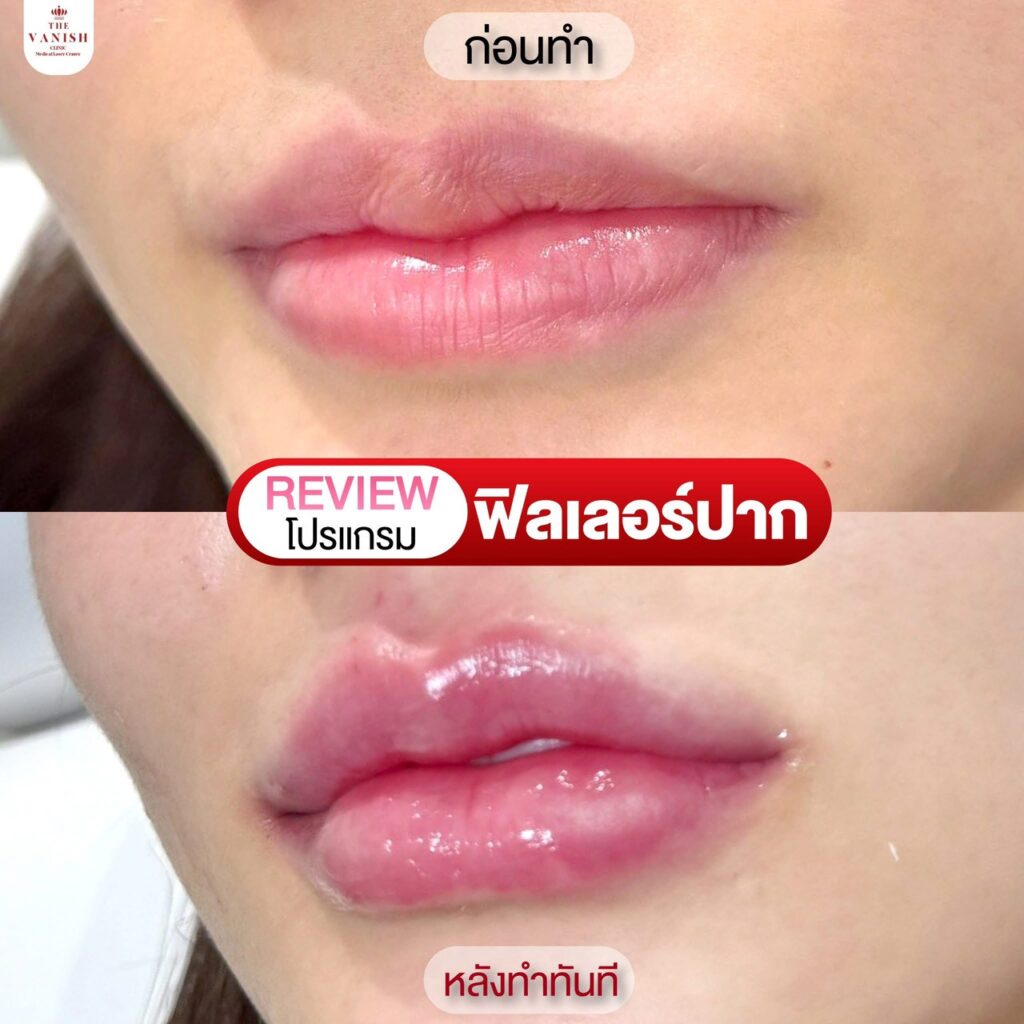 รีวิวฉีดฟิลเลอร์ปาก จากผู้ฉีดจริง The Vanish Clinic