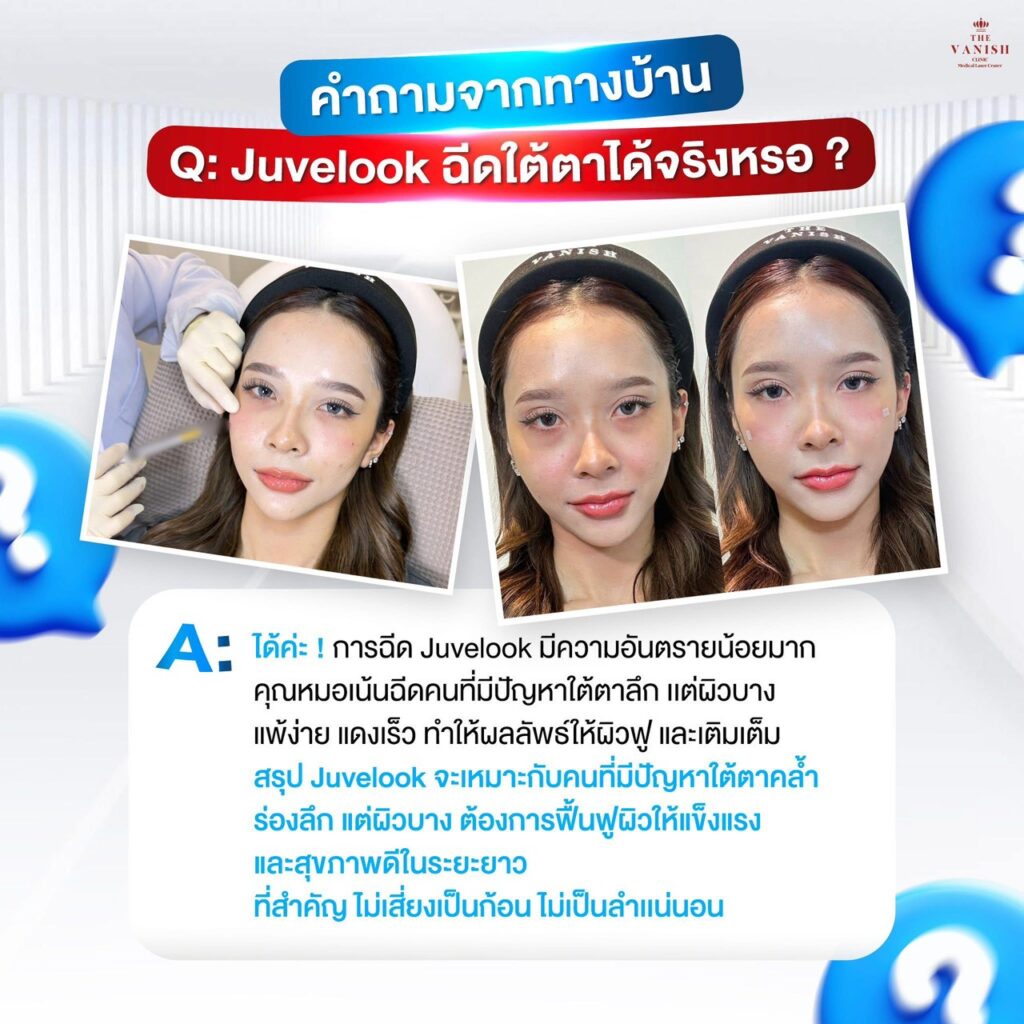 Juvelook ฉีดใต้ตาได้จริงหรอ