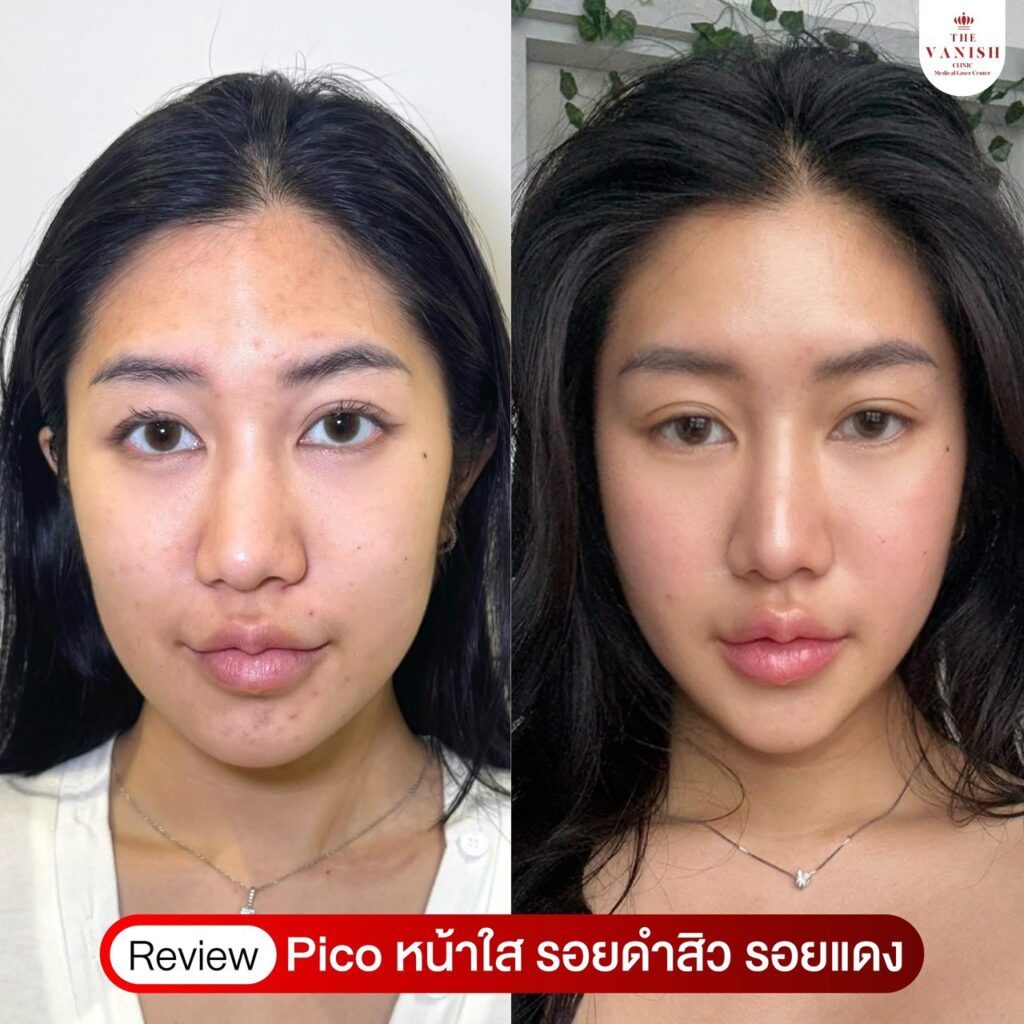 รีวิวเลเซอร์หน้าใสที่ The Vanish Clinic