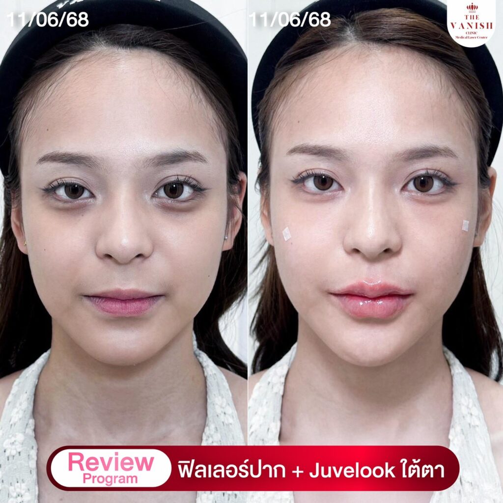 รีวิวฉีดฟิลเลอร์ปาก จากคนไข้ The Vanish Clinic