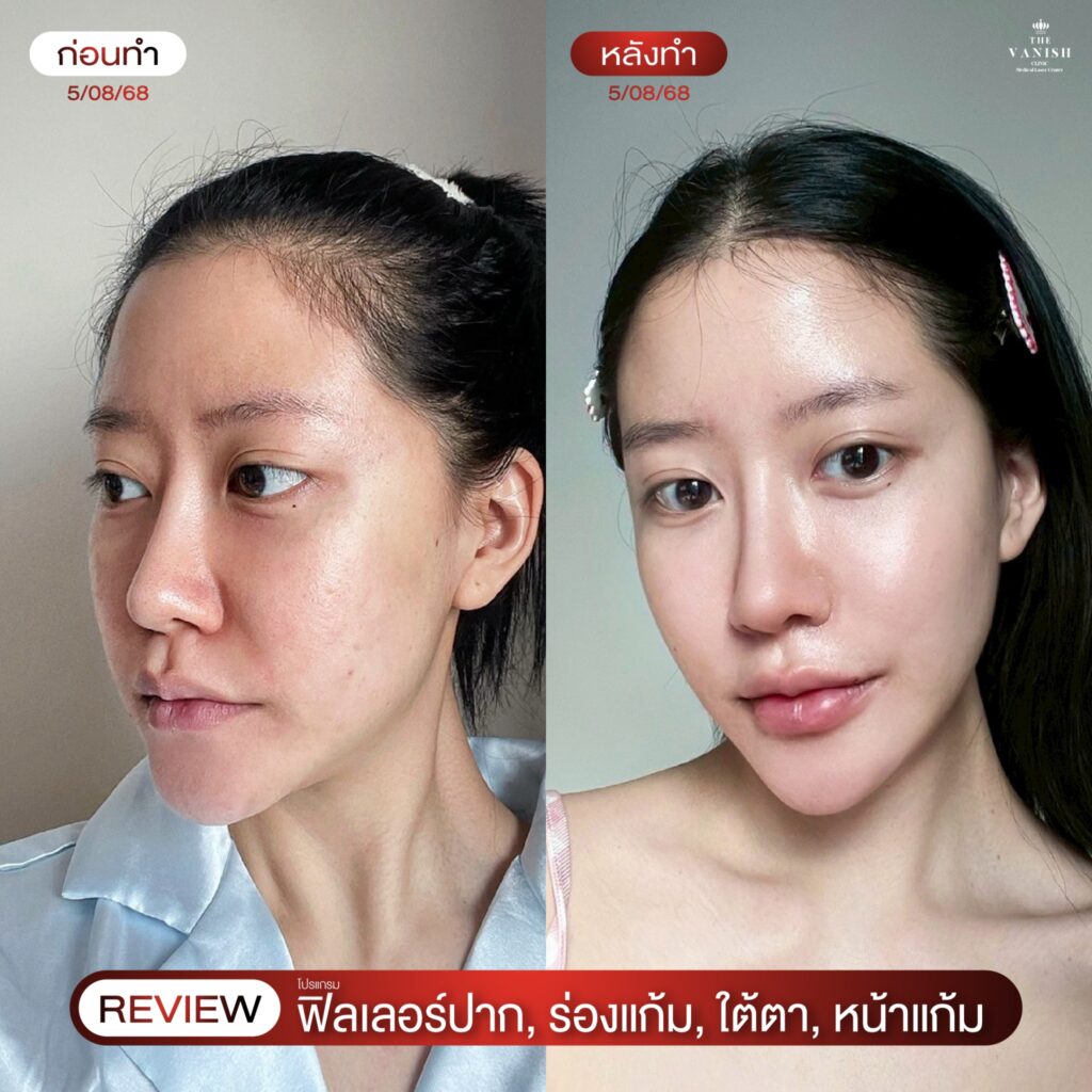 รีวิวจริง ฉีดฟิลเลอร์ปาก จาก The Vanish Clinic