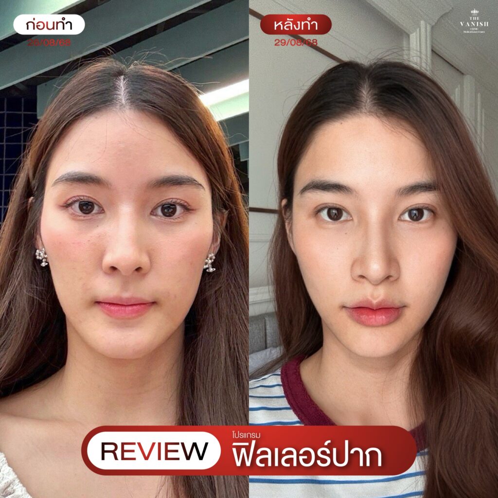 รีวิวฉีดฟิลเลอร์ปาก จากคนไข้ The Vanish Clinic