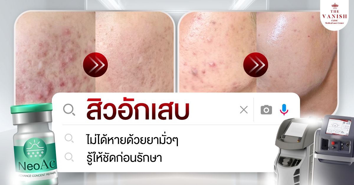 สิวอักเสบเกิดจากอะไร รักษายังไงดี